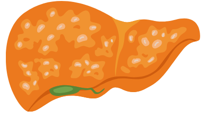 Graphic of Fatty Liver Disease