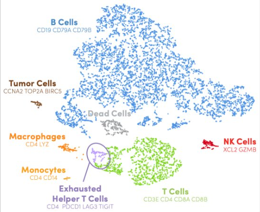 Gene Expression t-SNE: Showing B Cell (CD19 CD79A CD79B), Tumor Cells (CCNA2 TOP2A BIRC5), Macrophages (CD4 LYZ), Monocytes (CD4 CD14), Exhausted Helper T Cells (CD4 PDCD1 LAG3 TIGIT), T Cells (CD3E CD4 CD8A CD8B), NK Cells (XCL2 GZMB) and Dead Cells