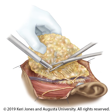 illustration of surgery. Copyright 2019 Keri Jones and Augusta University. All rights reserved.