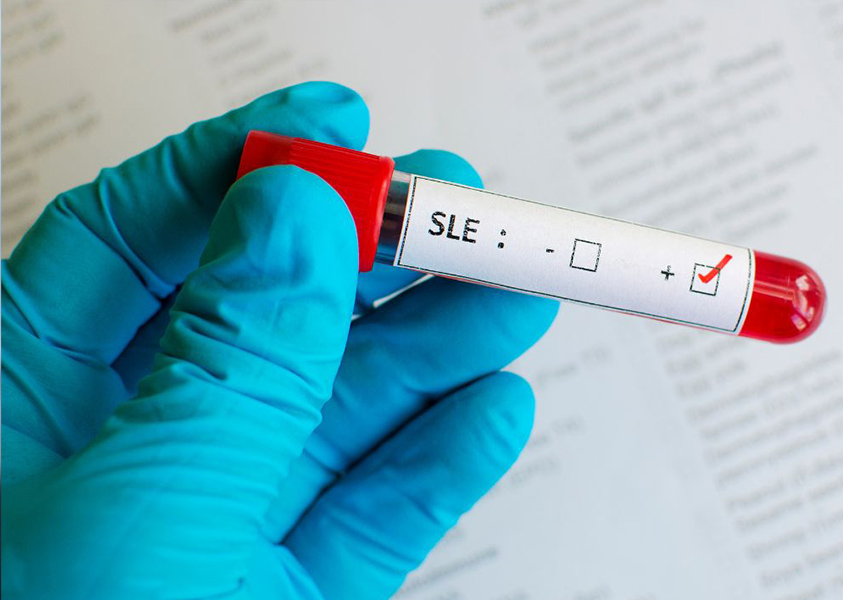 test tube with blood sample labeled SLE