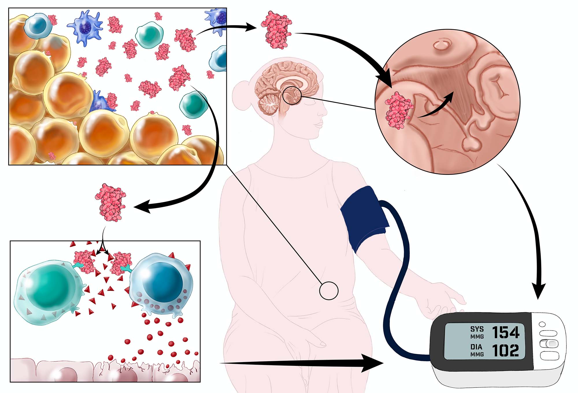 graphic illustration of a woman with SLE