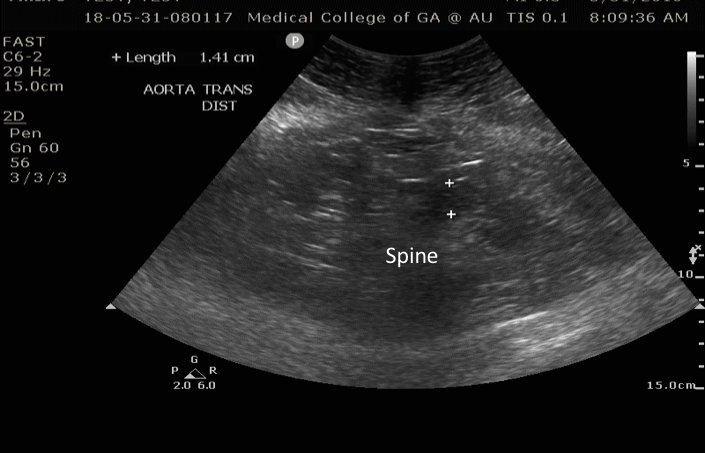 aorta transverse above bifurcation