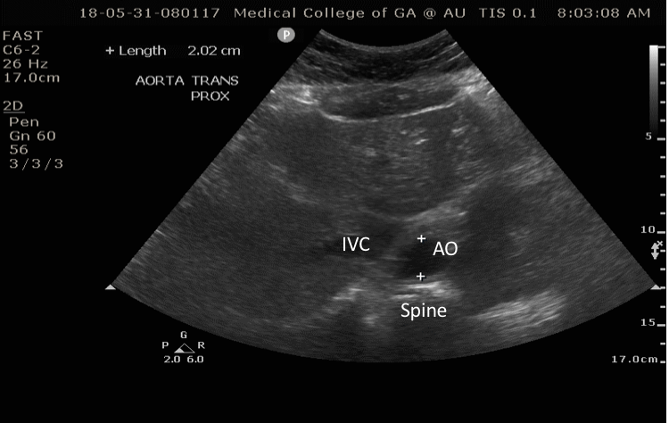 aorta transverse above sma