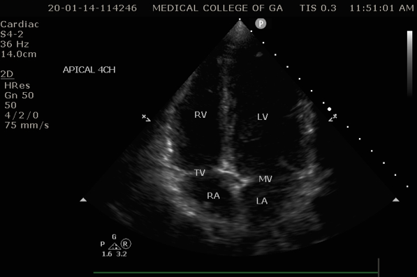 apical 4 chamber heart
